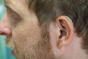 man with hearing loss wearing a hearing aid